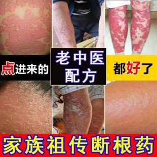 牛皮癣治疗偏方-专治牛皮皮癣偏方
