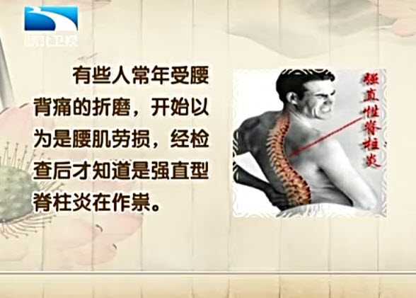强直性脊柱炎的早期症状是什么,女生强直性脊柱炎的早期症状是什么