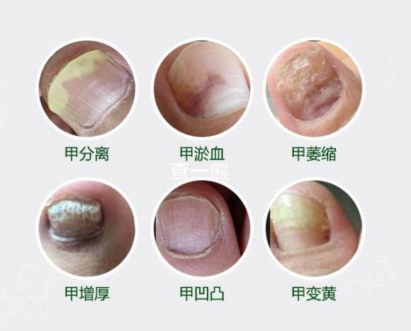 灰指甲症状,灰指甲症状怎么治疗