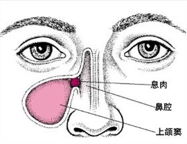 青少年鼻窦炎