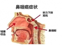 鼻咽癌的症状,鼻咽癌的症状和起因