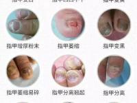 灰指甲症状,灰指甲症状怎么治疗