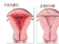 子宫内膜炎症状_什么原因导致子宫内膜炎症状